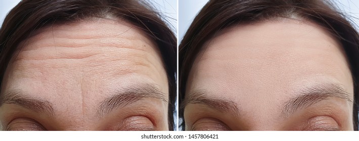 Female Forehead Wrinkles Before Treatment