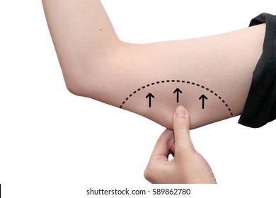 female grabbing skin on her upper armand  about to perform liposuction