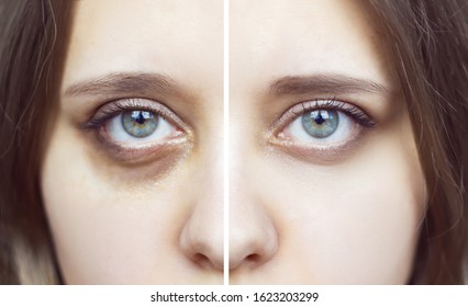 Female Green Eyes With Bruises Under Eyes Before And After Cosmetic Treatment. Dark Circles Under The Eyes