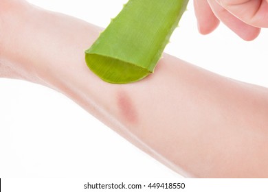 Female Hand Applying Aloe Vera Gel On A Skin Burn. Natural Alternative Medicine.