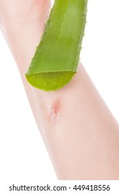 Female Hand Applying Aloe Vera Gel On A Skin Burn. Natural Alternative Medicine.