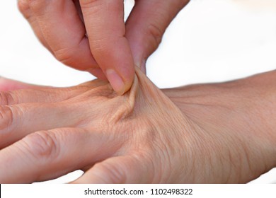 weibliche Hand einer älteren Frau mit lockerem Gewebe, entwässerter Haut