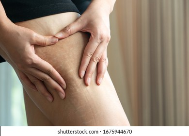 Female hand holds fat cellulite and stretch mark on leg at home, women diet style concept