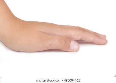 Female Hand With Warts Isolated On The White Background