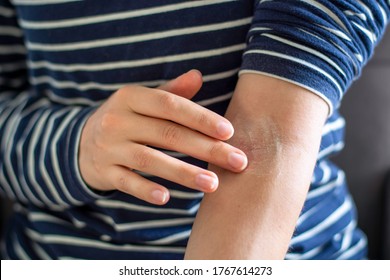 Female Hands Applying Ointment On Crook Of Arm / Elbow. Apply A Soothing Cream In The Treatment And Hydration Of Red Itchy Skin. Concept Of Skincare, Eczema, Allergy Rash And Other Skin Disease