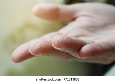 Female Hands Close Up, Dry Skin, Winter Skin Care 