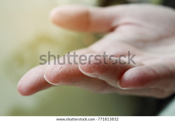 女性の手の接写 乾燥肌 冬の肌のケア の写真素材 今すぐ編集