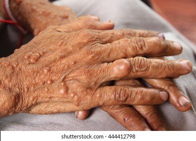 Female Hands Of Neurofibromatosis, Genetic Disorder That Causes Tumors On Skin.