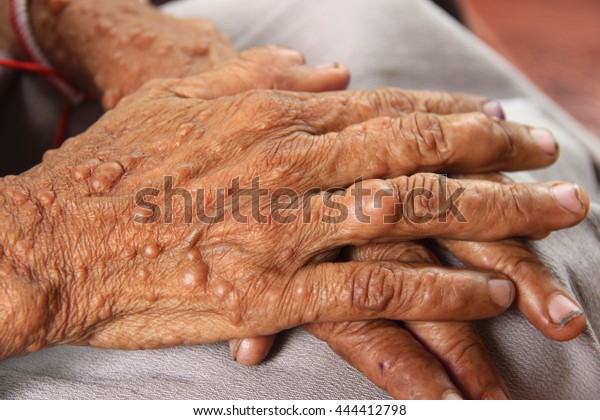 Female hands of neurofibromatosis, genetic disorder\
that causes tumors on\
skin.