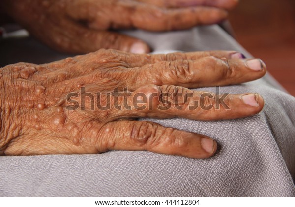 Female Hands Neurofibromatosis Genetic Disorder That Stock Photo ...