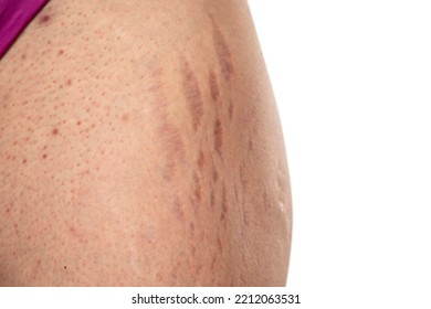 Female Hip With Stretch Marks And Groin With Dots Acne  Sensitive Problematic Skin On A White Background