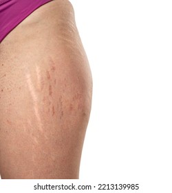 Female Hip With Stretch Marks And Groin With Dots Acne  Sensitive Problematic Skin On A White Background