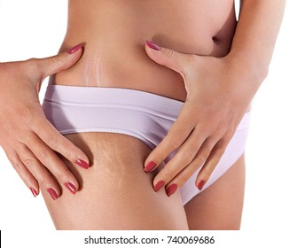 Female hips with visible stretch marks