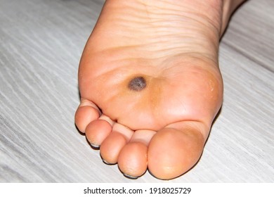 wart foot black