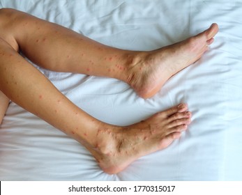 Female legs and many red spot   scar from sand fly bites in Thailand