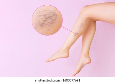 Female legs with varicose veins. Concept of human health and disease. Vascular diseases, problems of varicose veins. Enlarged image of blood vessels