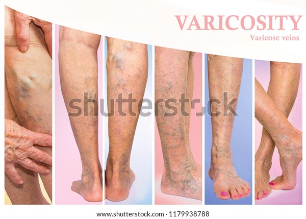 En dvt piernas cuidar como