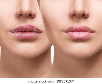 Female Lips With Herpes Sore Before And After Treatment.