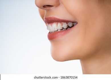 Female Mouth With Metal White Dental Braces Or Brackets