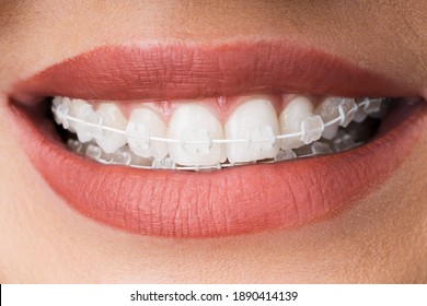 Female Mouth With Metal White Dental Braces Or Brackets