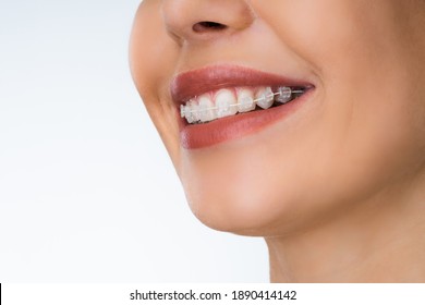 Female Mouth With Metal White Dental Braces Or Brackets