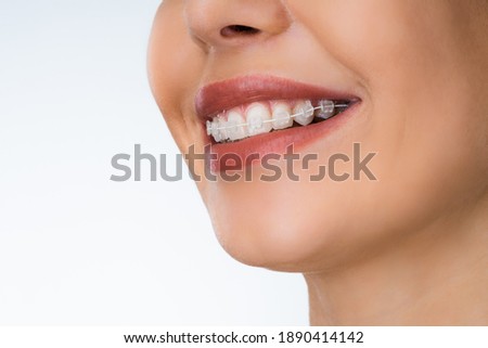 Female Mouth With Metal White Dental Braces Or Brackets