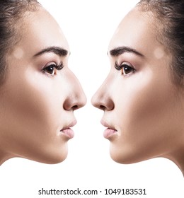 Female nose before and after cosmetic surgery.