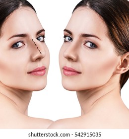 Female nose before and after cosmetic surgery