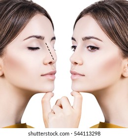 Female nose before and after cosmetic surgery