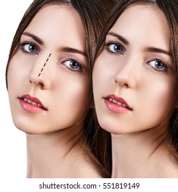 Female nose before and after cosmetic surgery