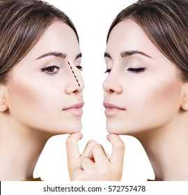 Female nose before and after cosmetic surgery