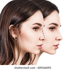Female nose before and after cosmetic surgery