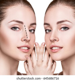 Female nose before and after cosmetic surgery.