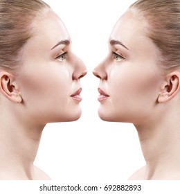 Female nose before and after cosmetic surgery.
