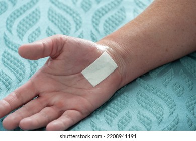 A Female Patient Has Their Hand Palm Up. The Wrist Has A Number Of Black Nylon Stitches From A Recent Carpal Tunnel Surgery. The Wound Is Closed With No Infection. Swelling Of The Fingers And Thumb. 