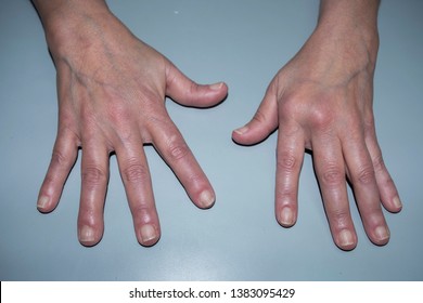 Female Patient With Rheumatoid Arthritis