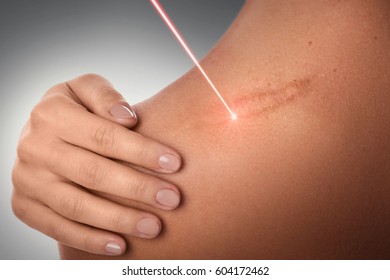 Female shoulder and laser beam during scar removal treatment