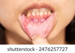 Female showing red and painful canker sore inside her lip.