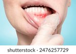 Female showing red and painful canker sore inside her lip.