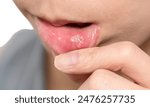 Female showing red and painful canker sore inside her lip.