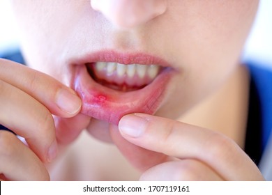 Female showing red and painful canker sore inside her lip - Shutterstock ID 1707119161