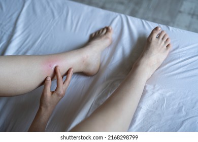 Female Sits On Bed At Home Applying Antiallergic Balm On Swollen Skin Leg From Mosquito Or Flea Bites, Suffering From Allergic Reaction And Swelling, Itchy Sore. Individual Intolerance To Insect Bites