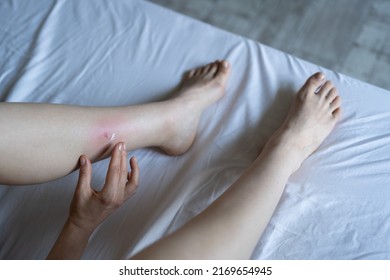 Female Sits On Bed At Home Applying Antiallergic Balm On Swollen Skin Leg From Mosquito Or Flea Bites, Suffering From Allergic Reaction And Swelling, Itchy Sore. Individual Intolerance To Insect Bites