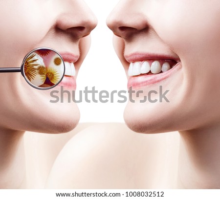 Female smile before and after teeth cleaning from germs.