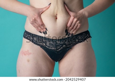 female stomach and legs covered in stretch marks with cellulite