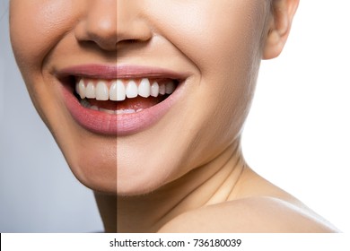 Weibliche Zähne und Haut vor und nach der Behandlung, Therapie und Erweißung.Lachen Mund mit großartigen Zähnen auf weißem Hintergrund. Gesunde schöne weibliche Lächeln. 