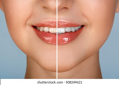 Female teeth whitening before and after the procedure, big lips mouth open, straight beautiful teeth. brush your teeth. Beautiful Smile for woman's face. White smooth natural teeth. Blue background