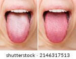 Female tongue with a white plaque. Comparison of a diseased tongue with a white plaque and a healthy clean tongue before and after treatment. The result of cleaning the tongue