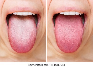 Lengua femenina con placa blanca. Comparación de una lengua enferma con una placa blanca y una lengua sana y limpia antes y después del tratamiento. Resultado de la limpieza de la lengua