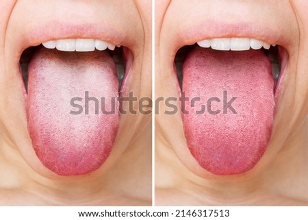 Female tongue with a white plaque. Comparison of a diseased tongue with a white plaque and a healthy clean tongue before and after treatment. The result of cleaning the tongue